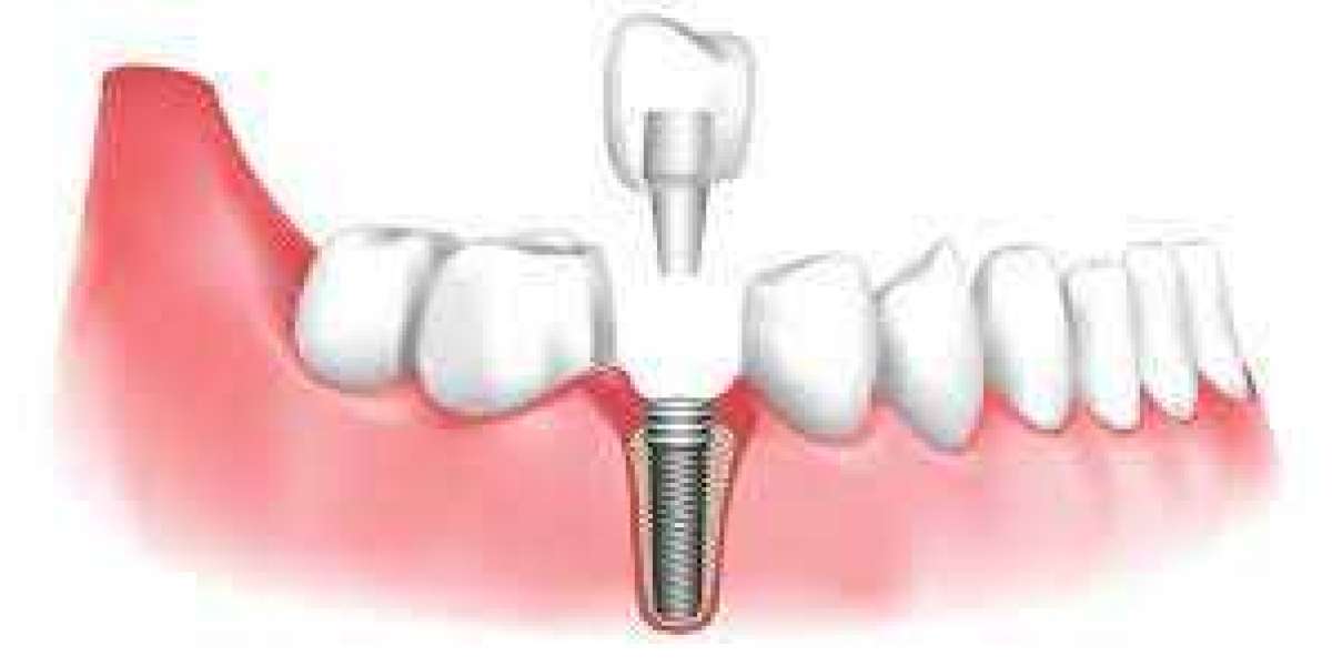 Enhance Your Smile with Dental Implants in St. Helens