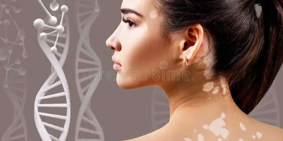 Treatment Innovations: Steps Towards Vitiligo Cure