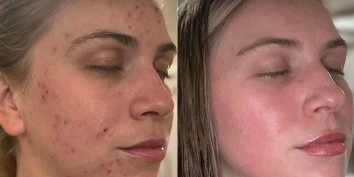 How quickly does Accutane work for acne?