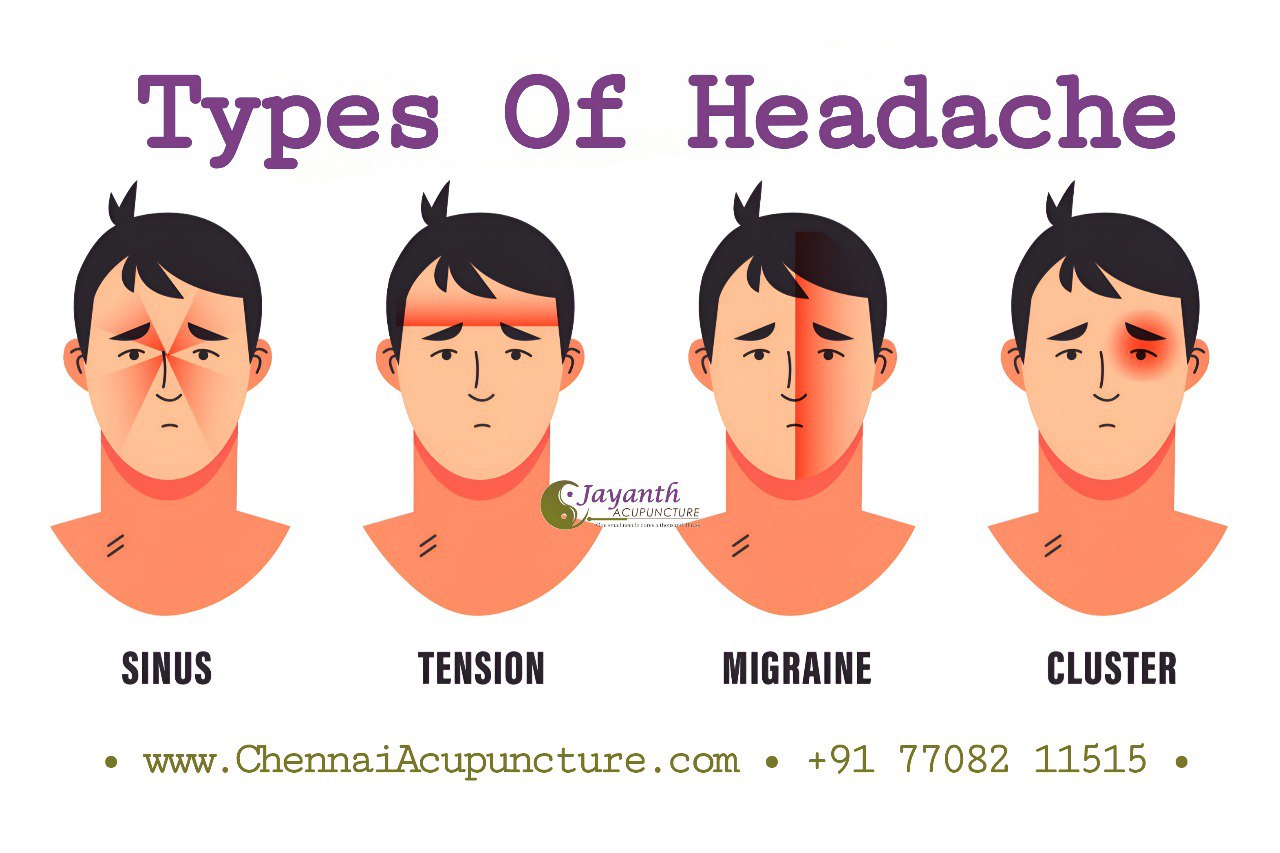 Acupuncture Treatment For Migraine & Headache in ChennaiBest Acupuncture Treatment by Well Experienced Acupuncture Doctor in Chennai